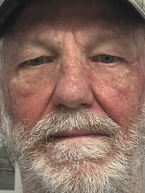 Day 6 (treatments completed)