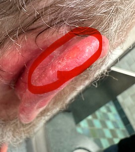 Surgical Area after Fluorouracil Treatment