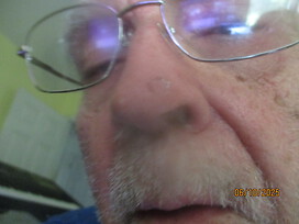 The lesion as of today no therapy