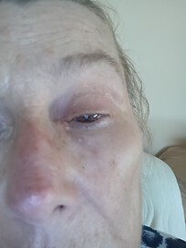 R medical canthus 7mm aprox.