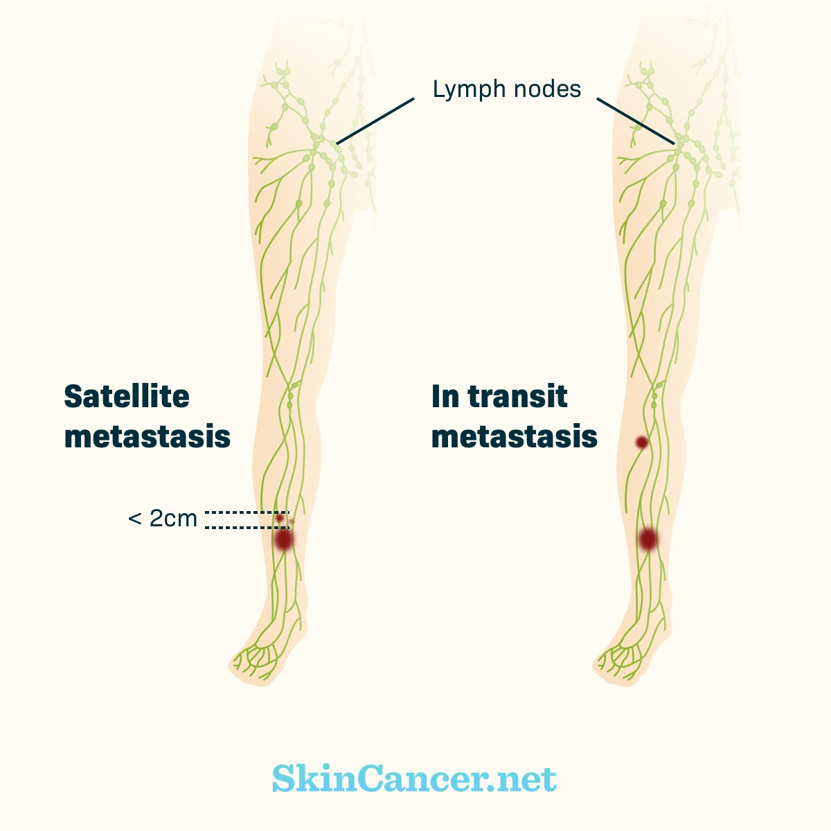 Red dots close together near the foot show satellite metastasis, while one red dot in the calf and one near the foot show in-transit metastasis