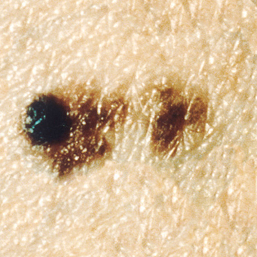 Dysplastic nevus evolving to melanoma