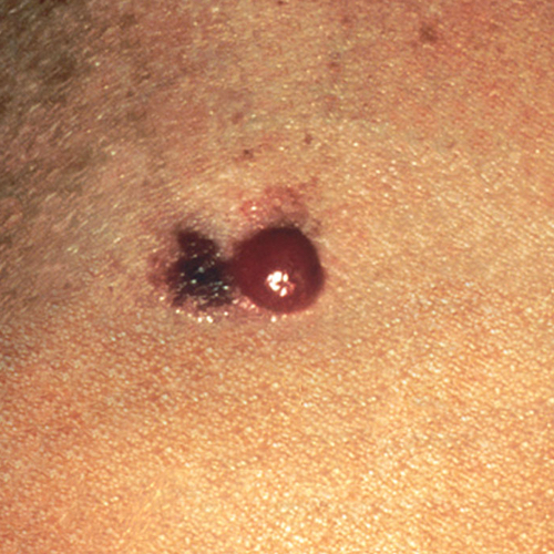 Advanced Malignant Melanoma