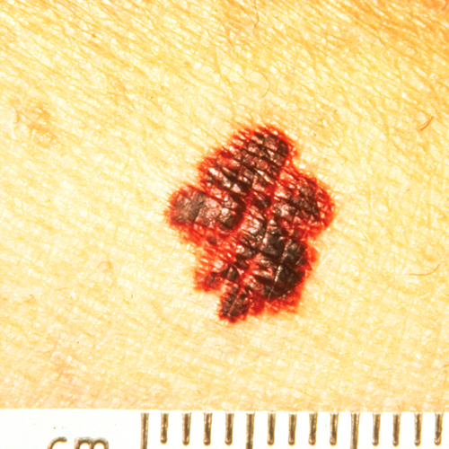 Melanoma uneven border