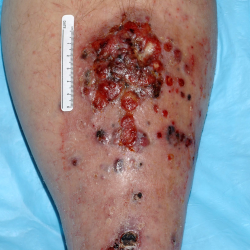 Metastatic melanoma