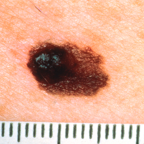 Asymmetrical Melanoma