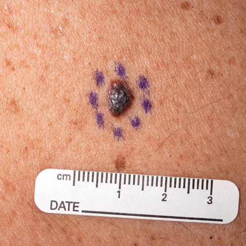 Malignant melanoma