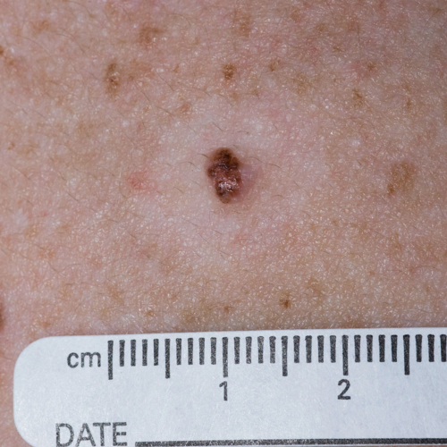 Malignant melanoma with halo