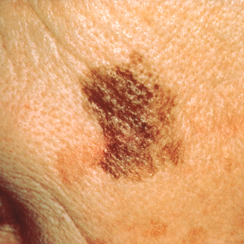 Melanoma Diameter Change