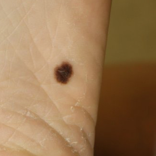 Melanoma on foot