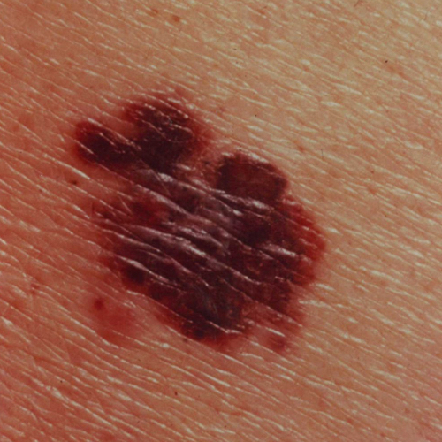 Melanoma red and brown lesion