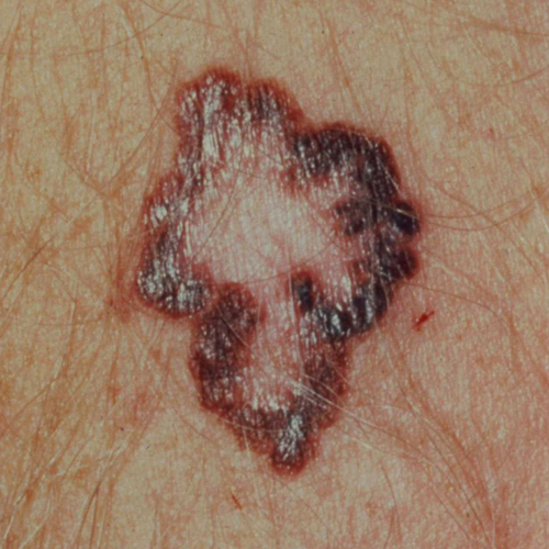 Melanoma uneven border, brown lesion